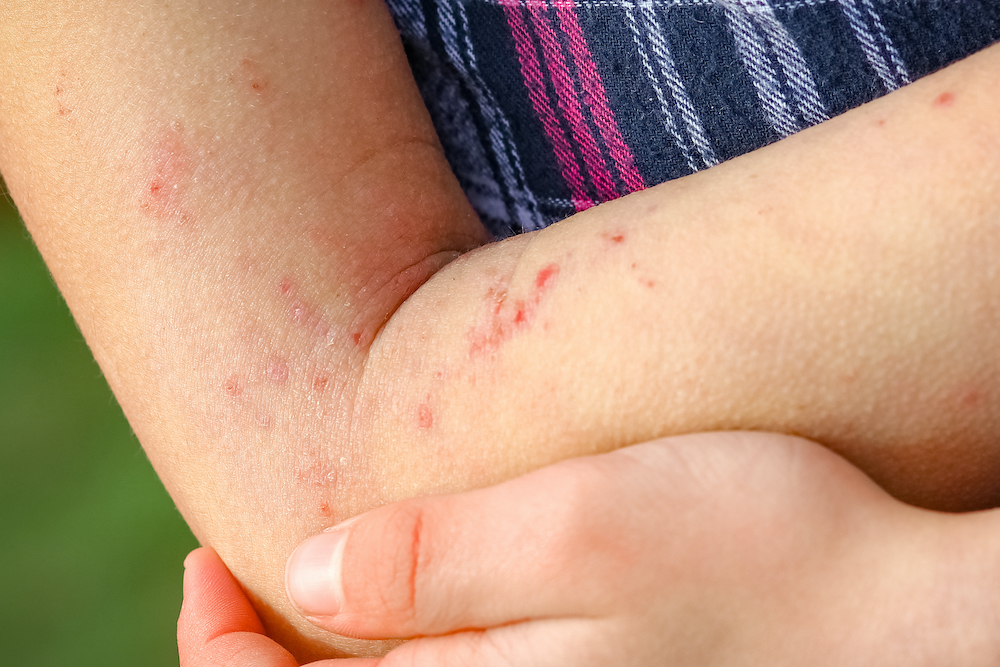 Dermatitis Kontak Alergi