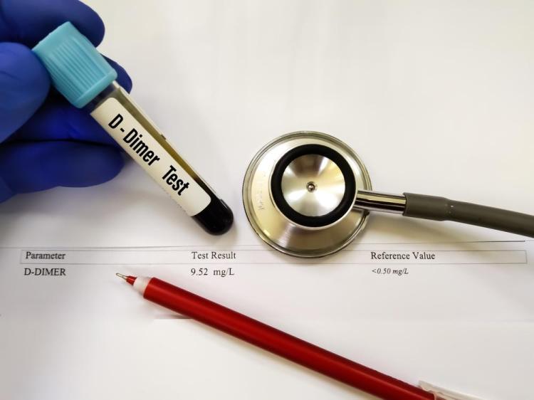Pentingnya Kadar DDimer dan CRP Normal untuk Pasien COVID19