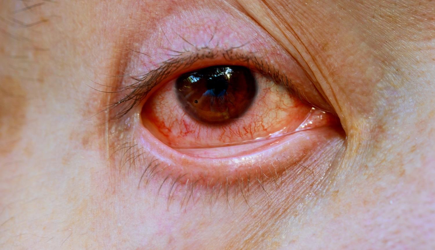 Mengenal Toksoplasmosis pada Mata yang Bisa Menyebabkan Kebutaan