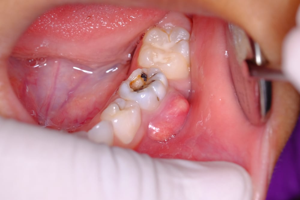 abses merupakan penyebab pipi bengkak karena sakit gigi