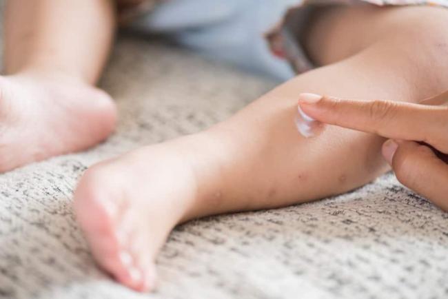 5 Obat Cacar Air di Apotek dan Perawatan Rumahannya