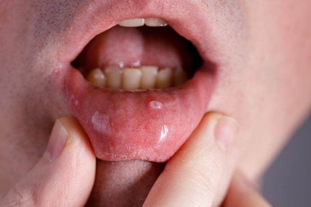 Mukokel: Obat, Penyebab, Gejala, dll. - Hello Sehat