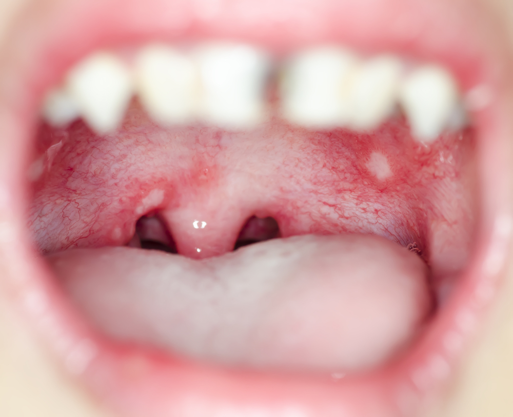 7 Kondisi yang Menyebabkan Benjolan di Mulut
