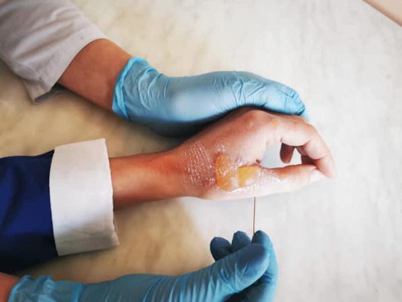 Xeroderma Pigmentosum