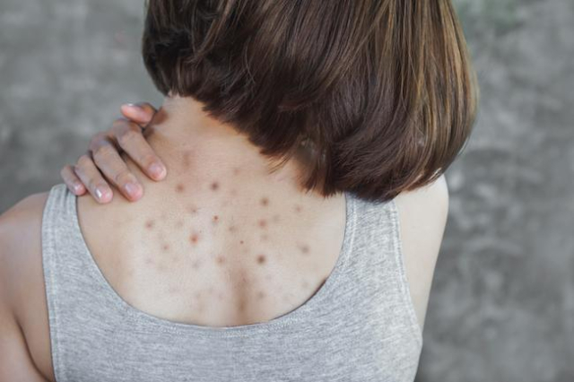 15 Cara Jitu Menghilangkan Jerawat di Punggung - Hello Sehat