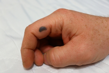 Blood Blister