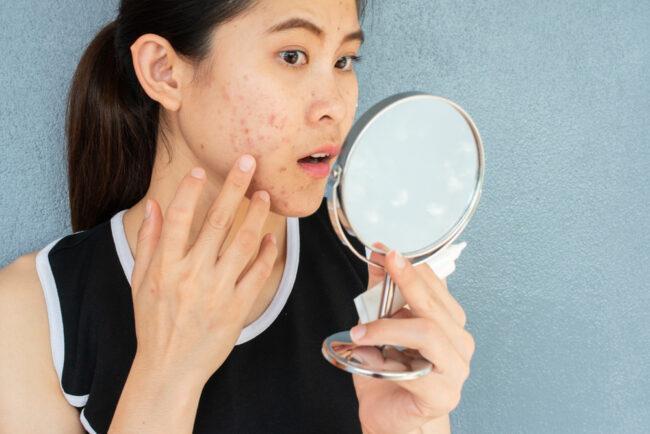 8 Serum Penghilang Bekas Jerawat yang Harganya Terjangkau