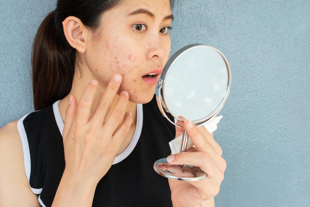 8 Rekomendasi Serum Penghilang Bekas Jerawat - Hello Sehat