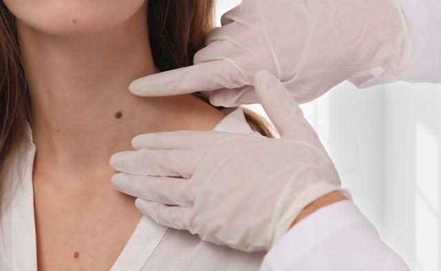 skin-tag-pada-ibu-hamil