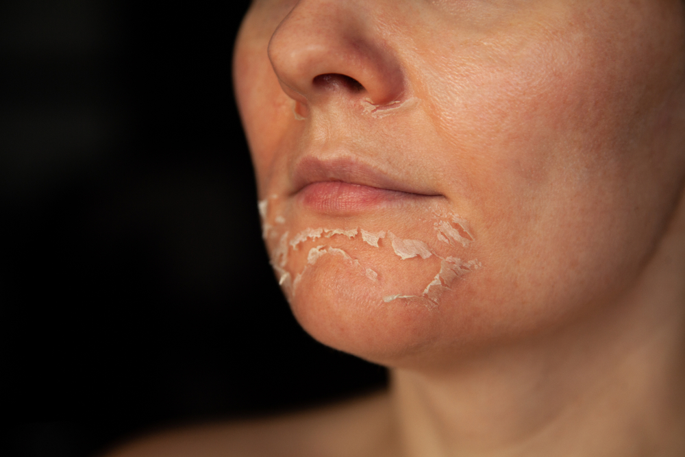 Peeling Skin Syndrome, Kondisi Kulit yang Mudah Mengelupas