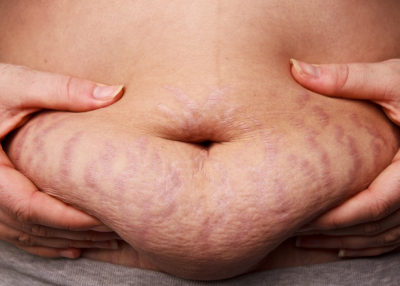 perbedaan stretch mark merah dan putih