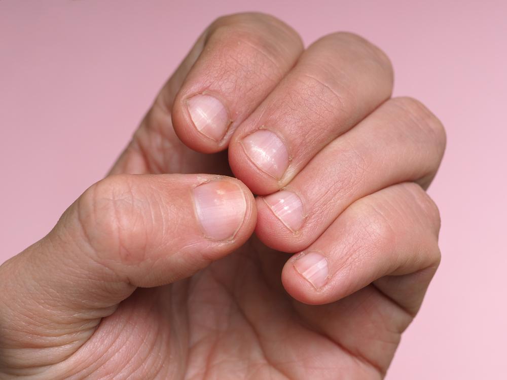 Garis Mees pada Kuku