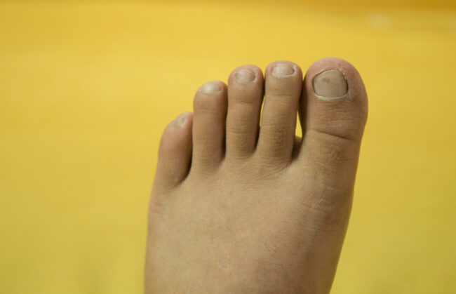 yellow-nail-syndrome