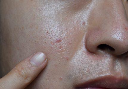 Kenali Masalah Sel Kulit Mati dan Cara Perawatannya