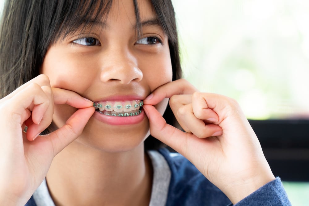 cara merawat gigi behel, cara merawat kawat gigi, perawatan gigi behel