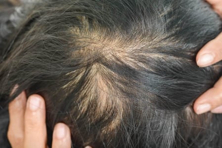 5 Penyebab dan Kebiasaan yang Membuat Rambut Tipis