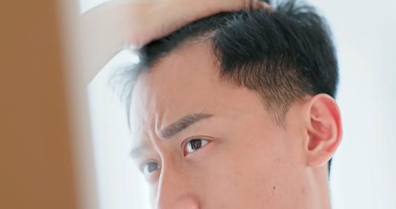 Garis Rambut Sepanjang Dahi Mundur? Ini 5 Penyebabnya