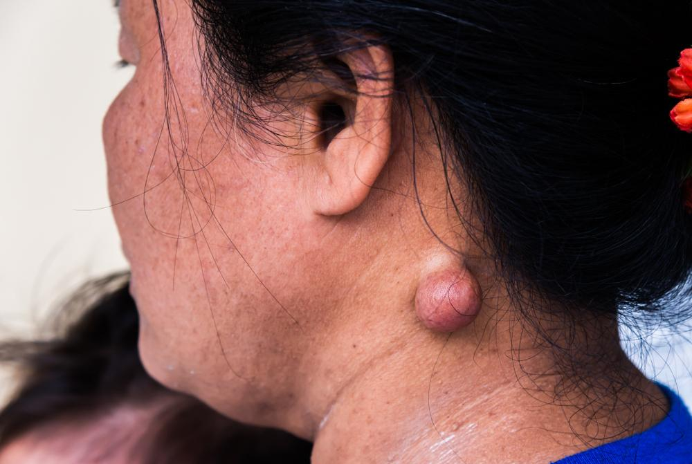 Kista Epidermoid: Obat, Penyebab, Gejala, dll. - Hello Sehat