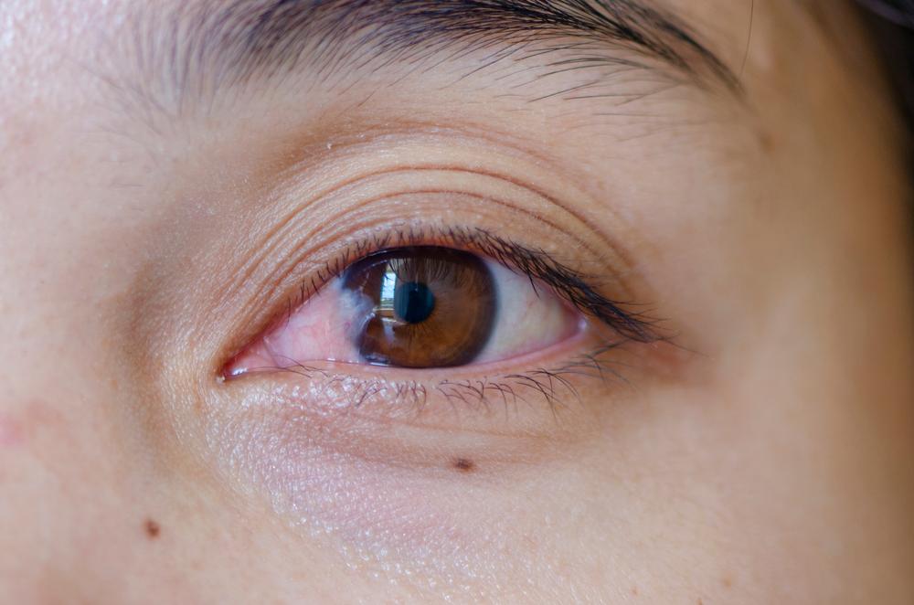 Timbul Bintik Putih di Mata? Berikut Kemungkinan Penyebabnya