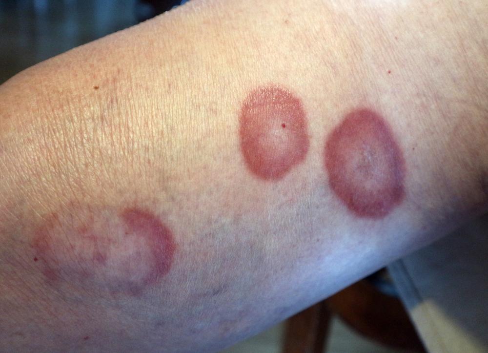 Granuloma, Benjolan yang Menandakan Peradangan pada Tubuh