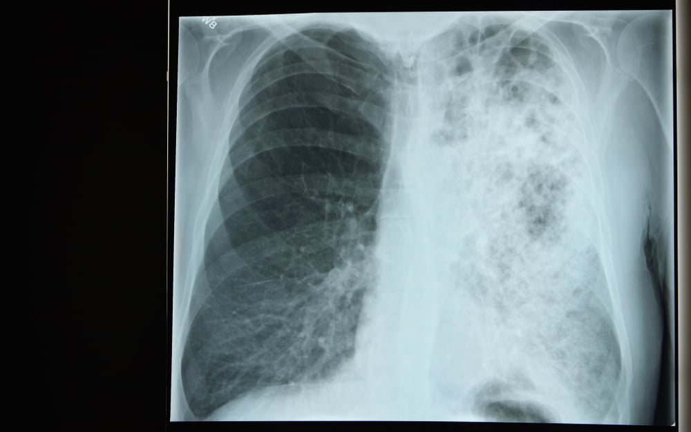 Penyakit Legionnaires, Pneumonia Parah yang Berakibat Fatal