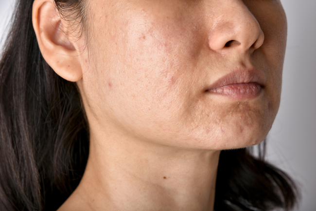 6 Cara Alami Mengatasi Beruntusan akibat Skincare