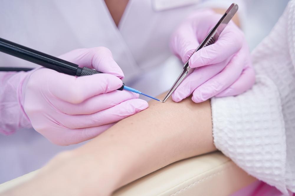 Manfaat Cauter, Prosedur untuk Atasi Kelainan pada Kulit