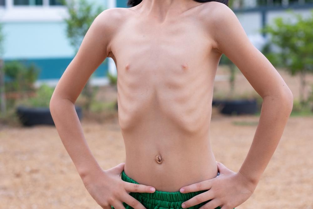 Busung Lapar, Kondisi yang Berkembang Akibat Gizi Buruk