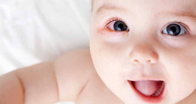 5 Penyebab Mata Bayi Merah dan Cara Mengatasinya
