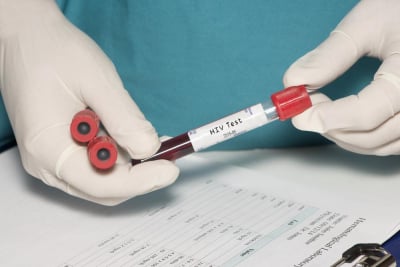 tes hiv di jakarta, semarang, dan bandung