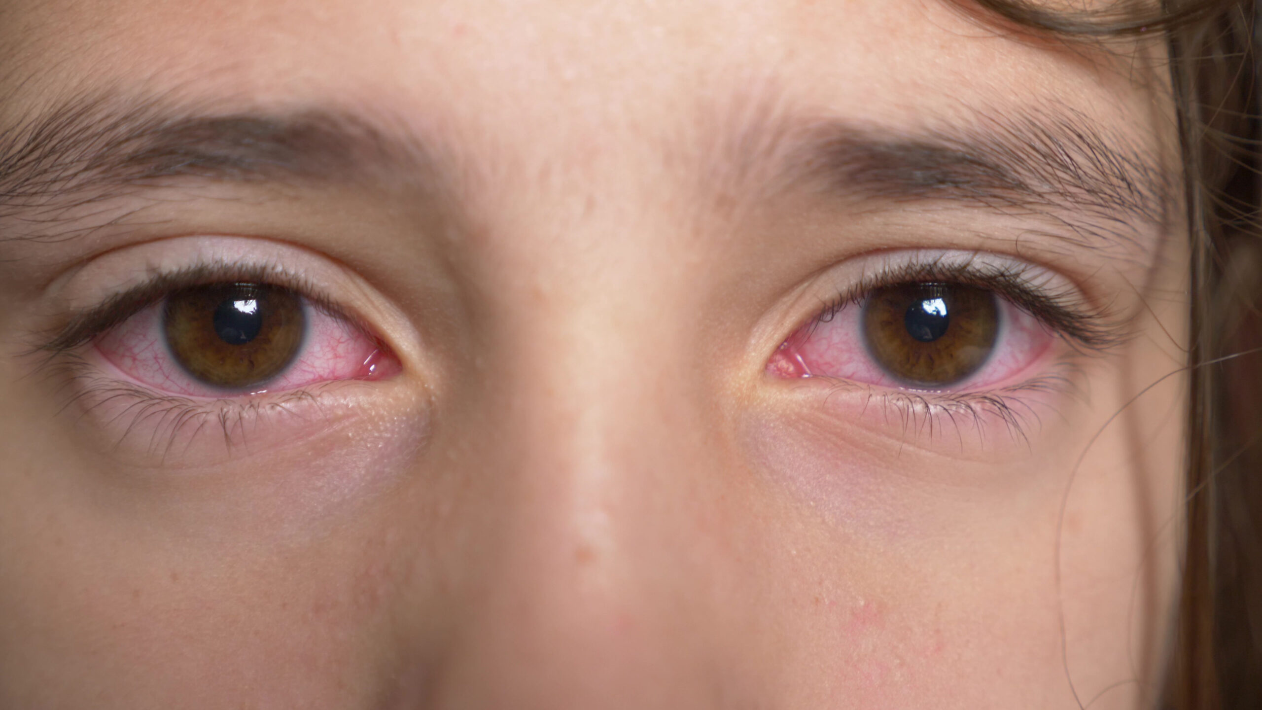 6 Penyebab Mata Merah pada Anak dan Pengobatannya