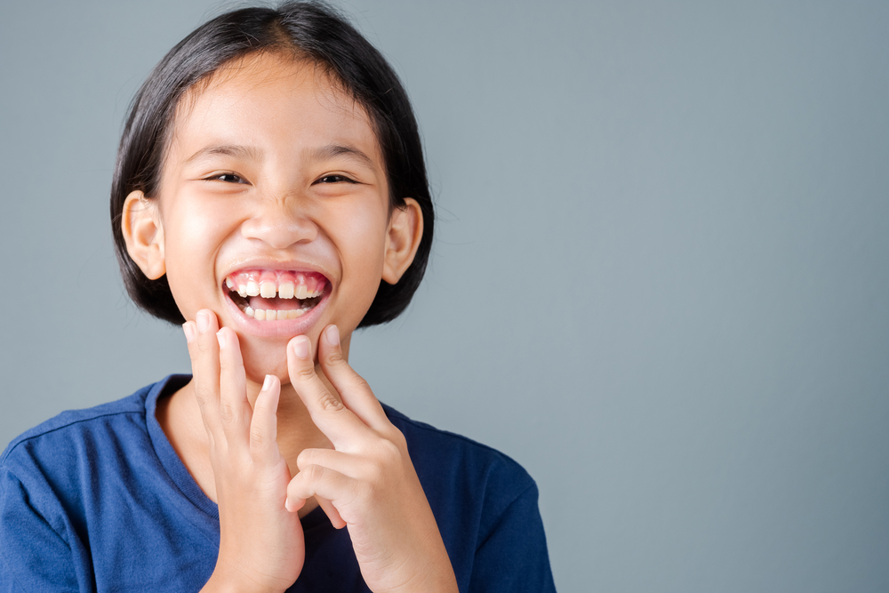 Gummy Smile, Ketika Gusi Lebih Terlihat Saat Tersenyum