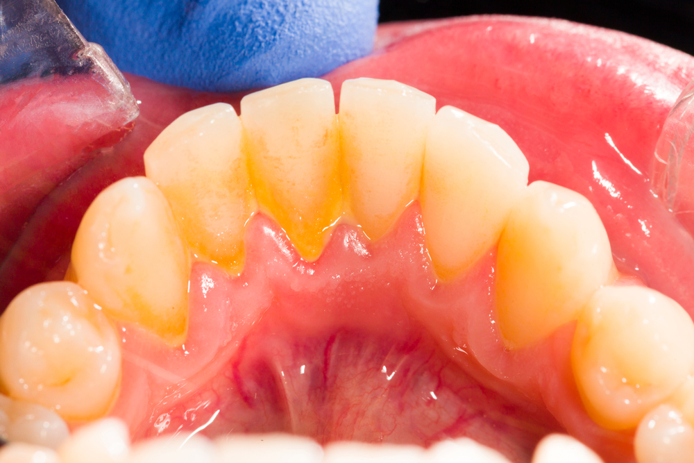 perbedaan plak dan karang gigi