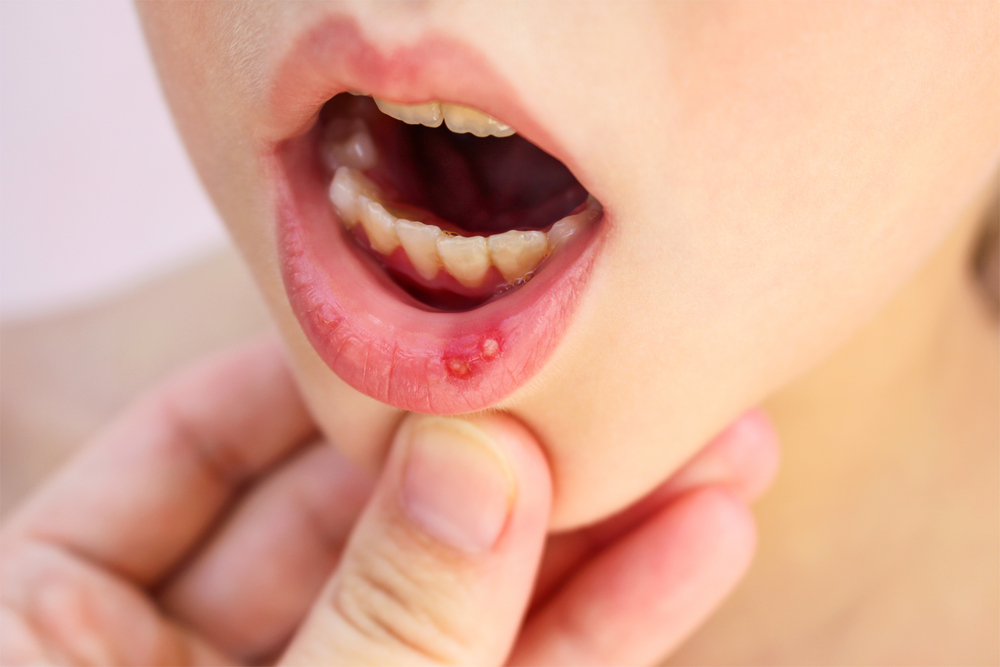 8 Penyakit yang Rawan Menyerang Mulut Manusia