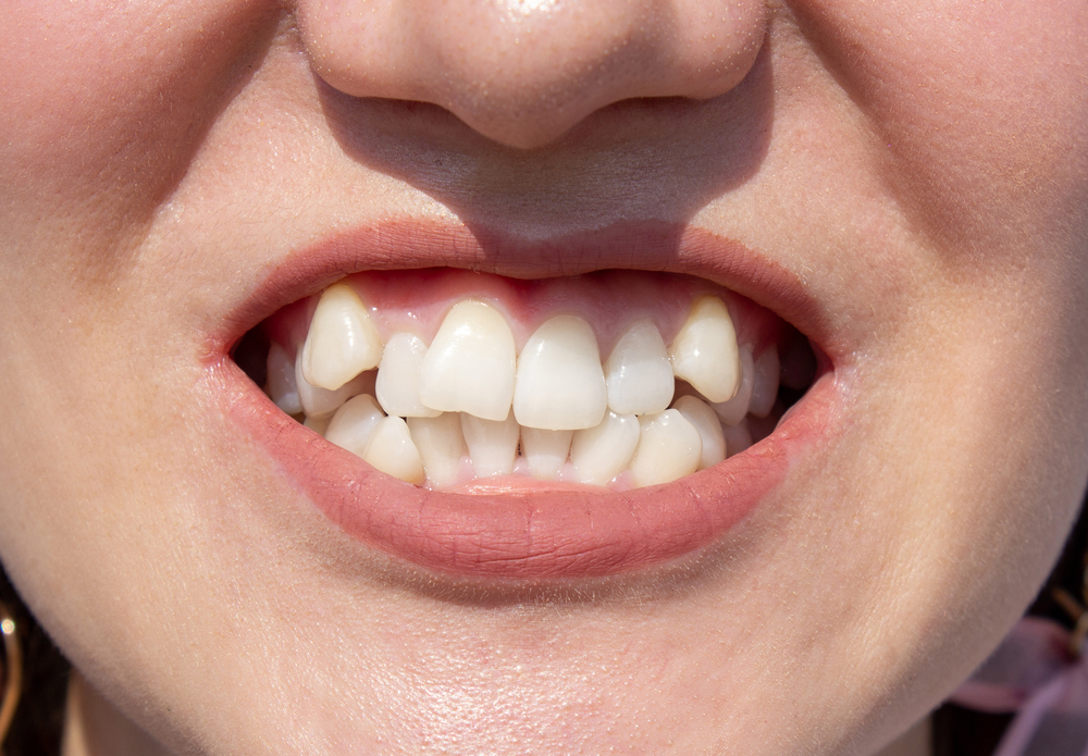 Adakah Cara Membuat Gigi Gingsul Secara Alami? Hello Sehat