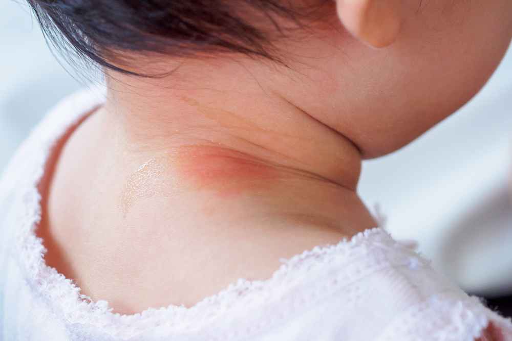 5 Penyebab Leher Bayi Merah serta Cara Mengatasinya