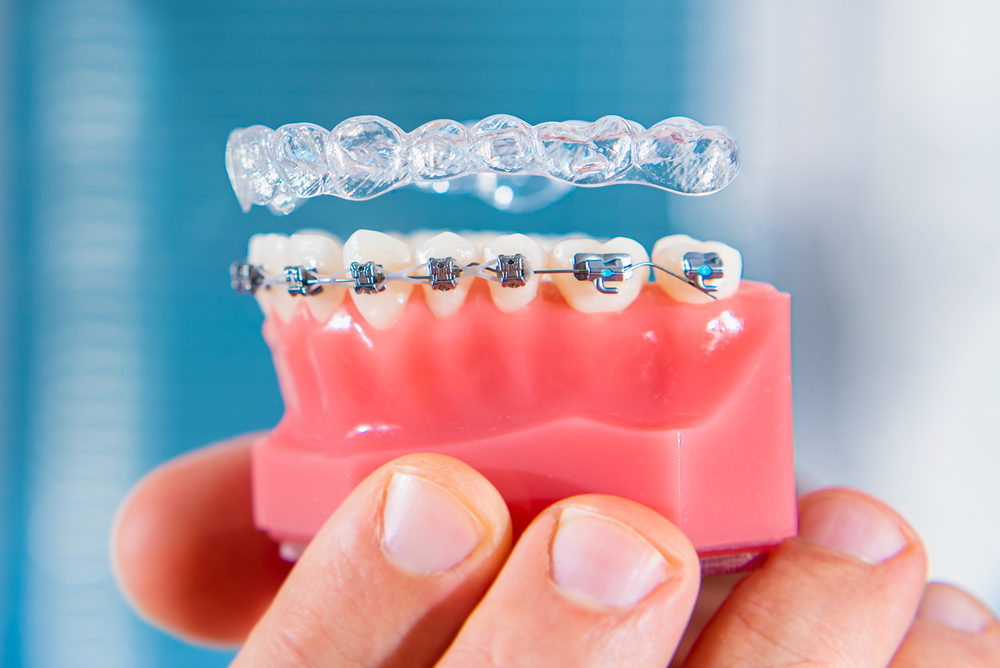 Aligner vs Behel, Mana yang Lebih Bagus?