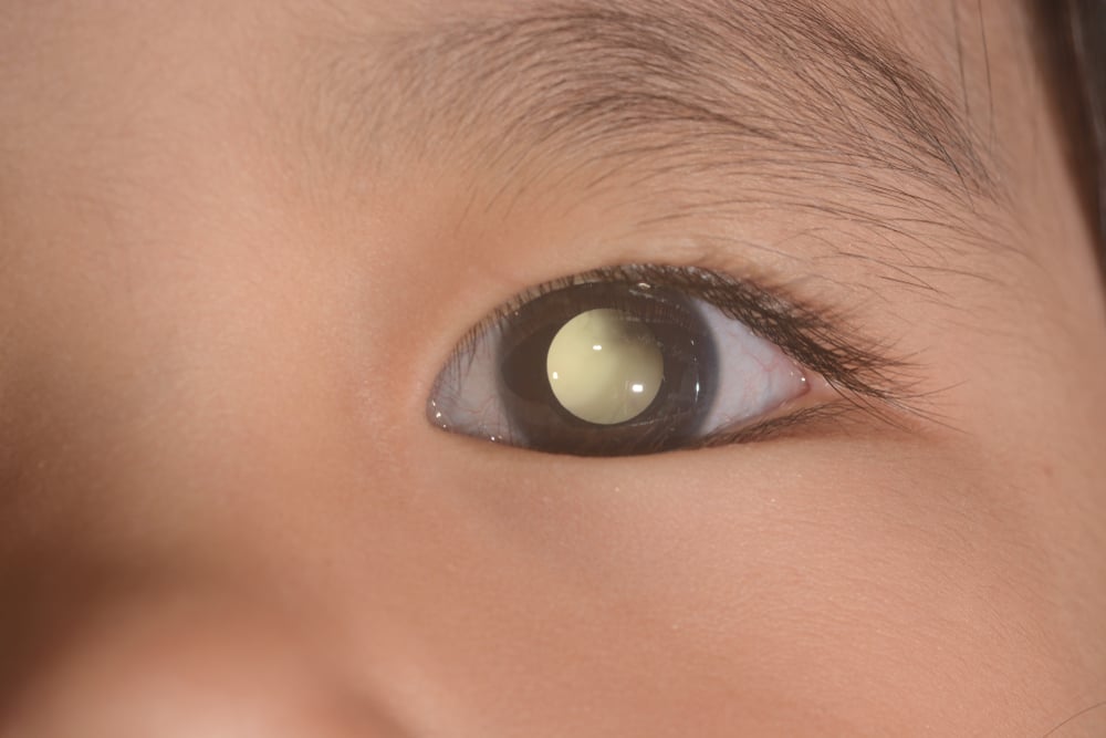 deteksi dini retinoblastoma