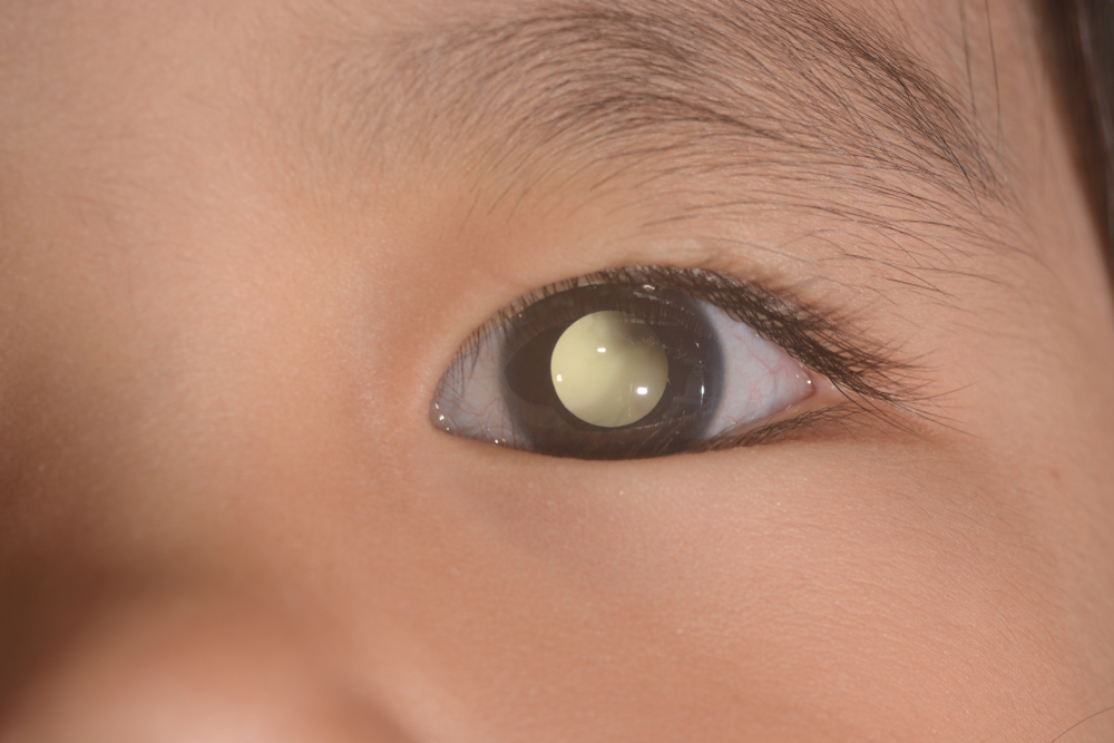 deteksi-dini-retinoblastoma