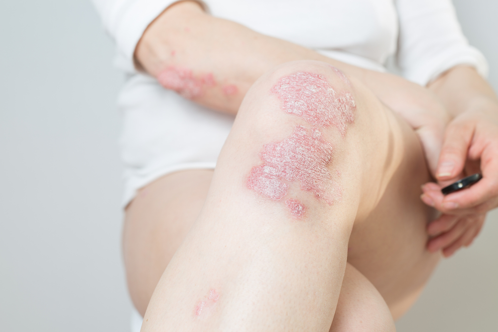 Apakah Psoriasis Bisa Sembuh Total? Ketahui Faktanya