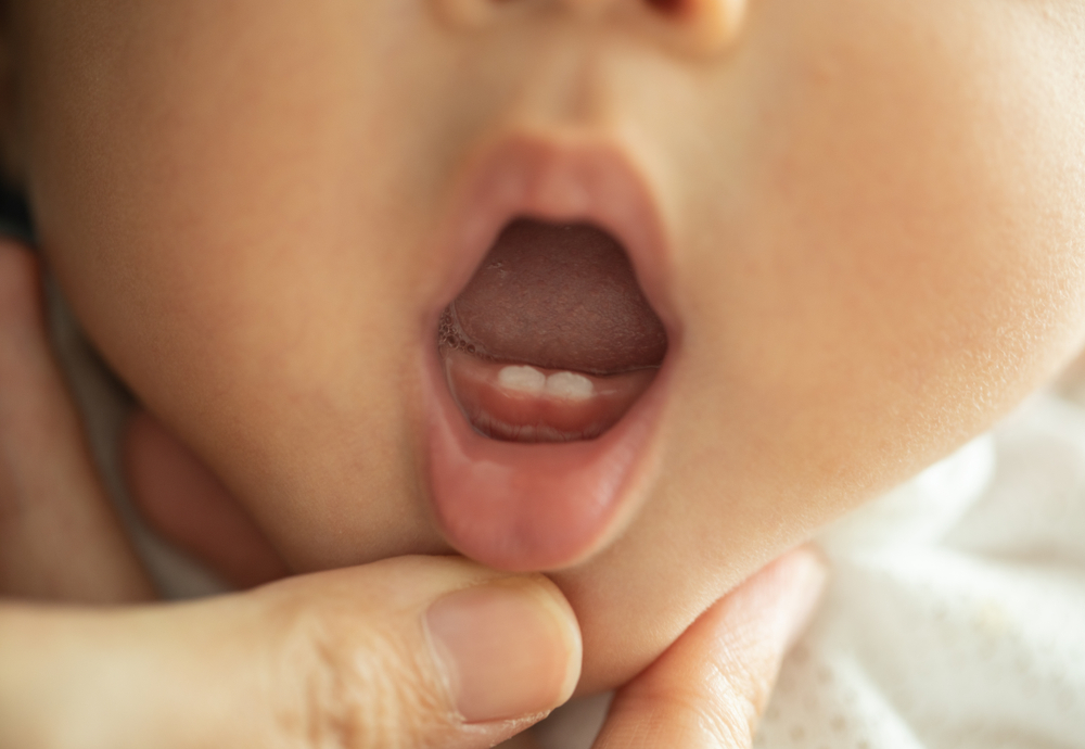 Gigi Bayi Kuning? Kenali Penyebab dan Cara Mengatasinya