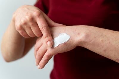 Obat gatal kulit pada tangan