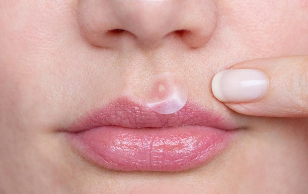 10 Rekomendasi Acne Patch Terbaik untuk Hempaskan Jerawat