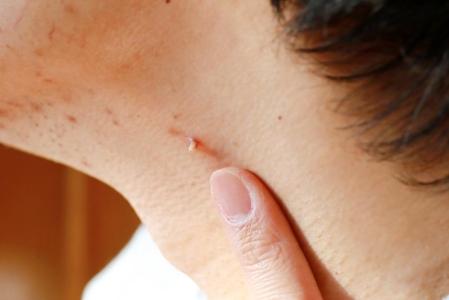 Kutil di Leher, Inilah Penyebab dan Cara Mengatasinya