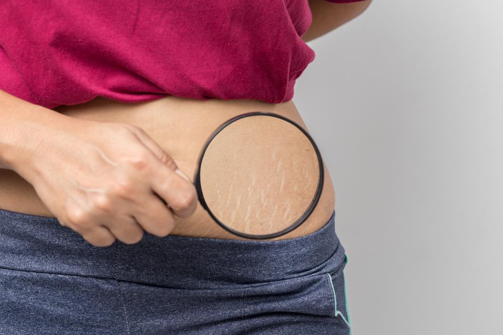 5 Penyebab dan Cara Mengatasi Stretch Mark pada Remaja