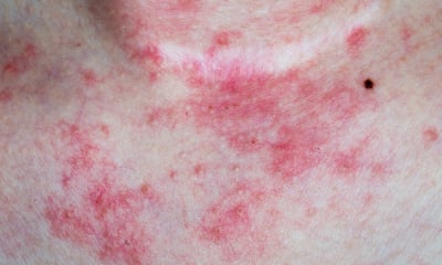 Tanda gejala eksim dermatitis atopik seperti apa