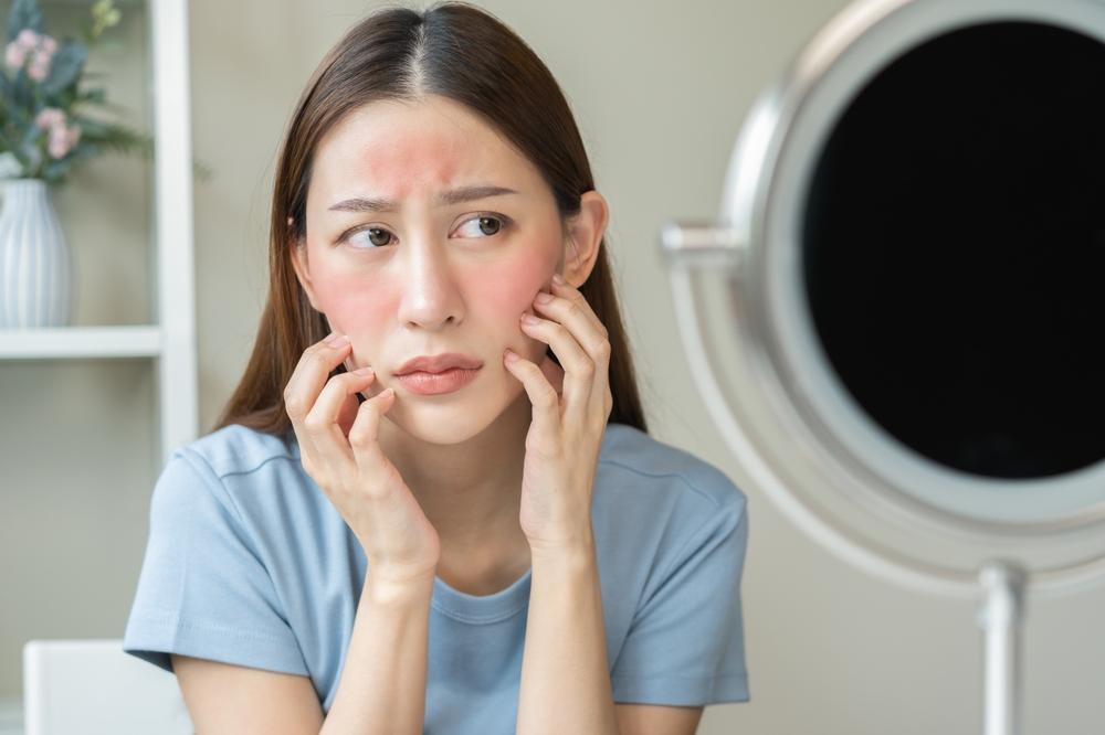 Bisakah Eksim pada Wajah Sembuh? Yuk, Cari Tahu! - Hello Sehat