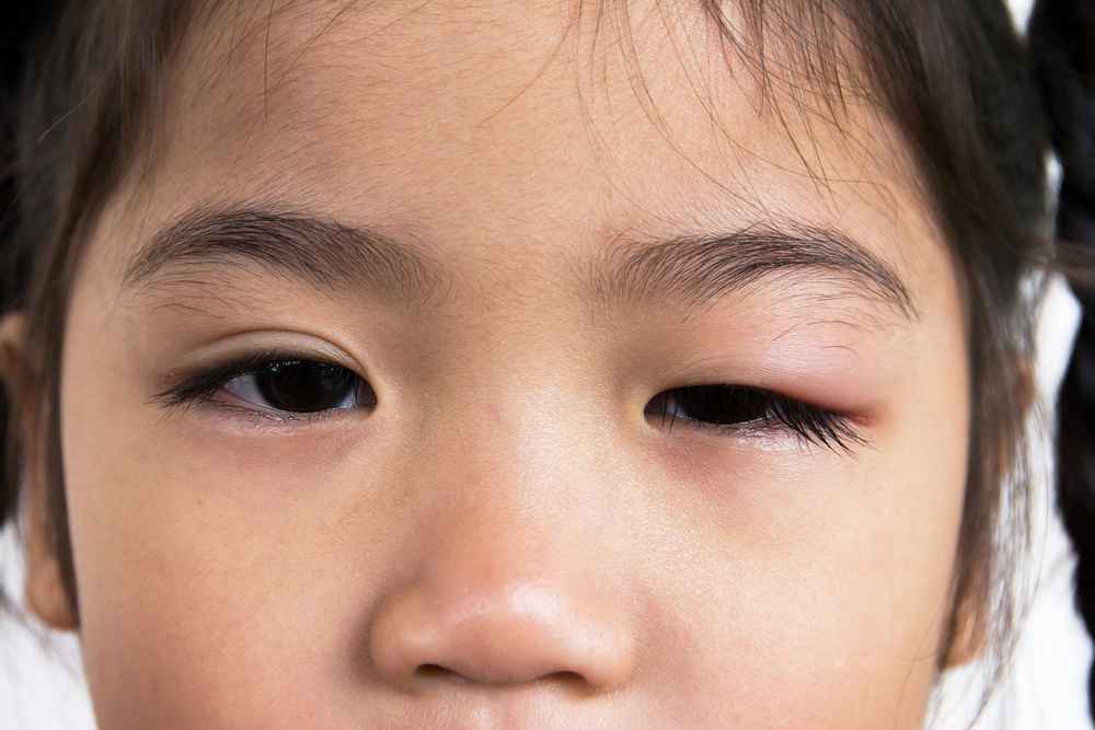 5 Cara Mengatasi Mata Bintitan pada Anak serta Penyebabnya