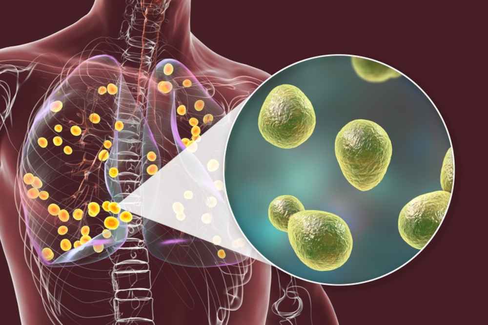 infeksi jamur histoplasma capsulatum