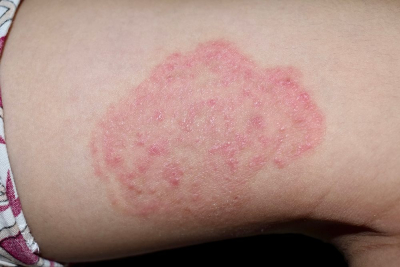 Gambar tinea corporis ringworm